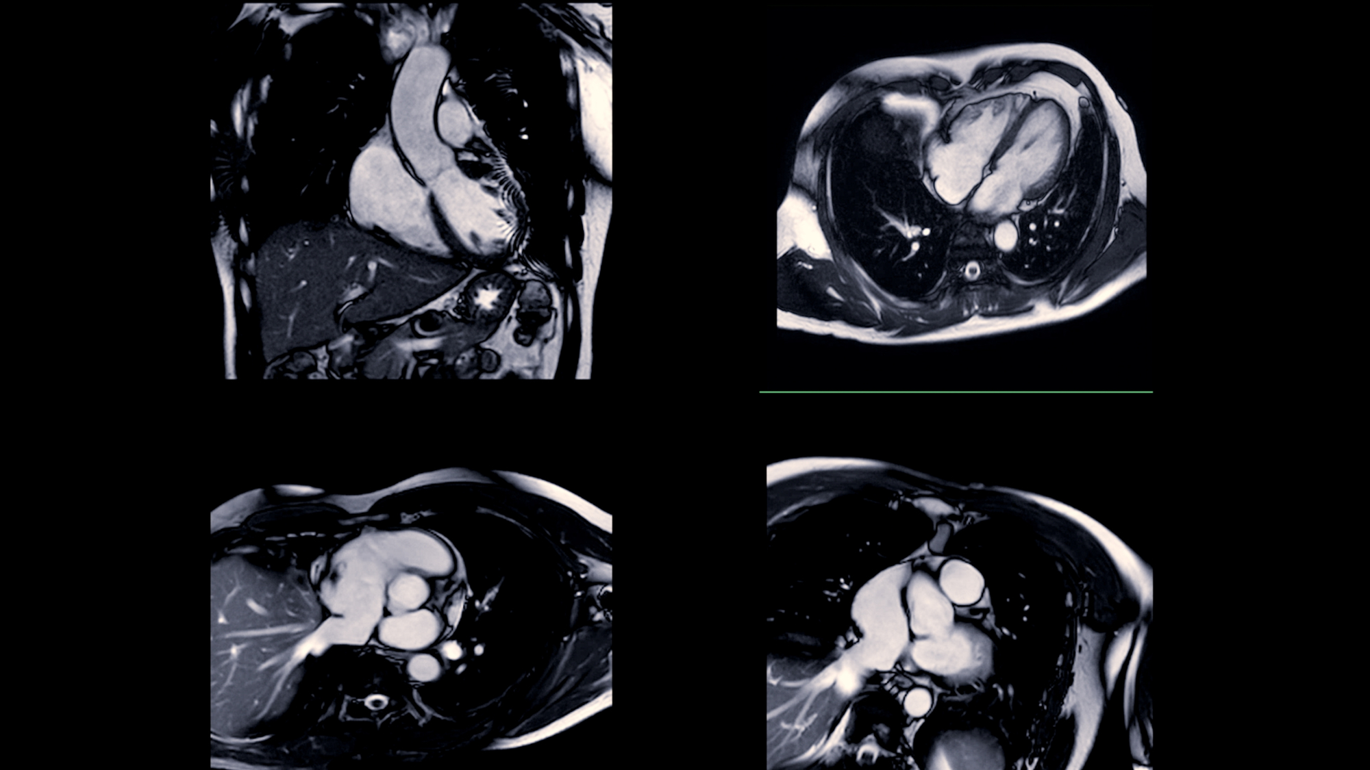 Cardiac MRI